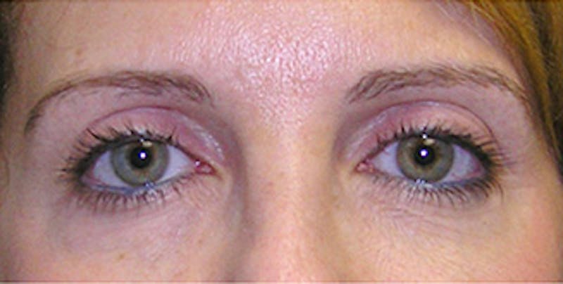 Eyelid Surgery Before & After Gallery - Patient 197125 - Image 1