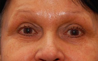 Fillers Before & After Gallery - Patient 416688 - Image 2