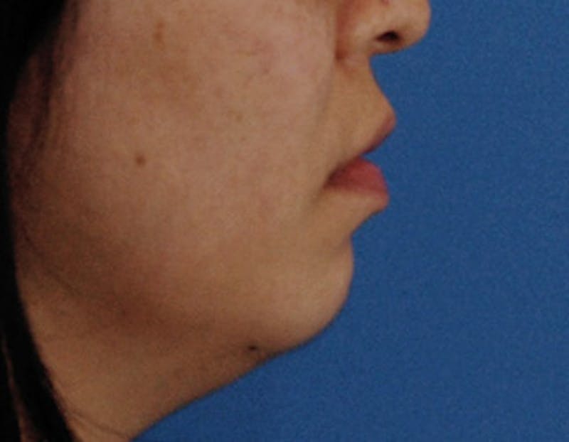 Kybella Before & After Gallery - Patient 379605 - Image 5