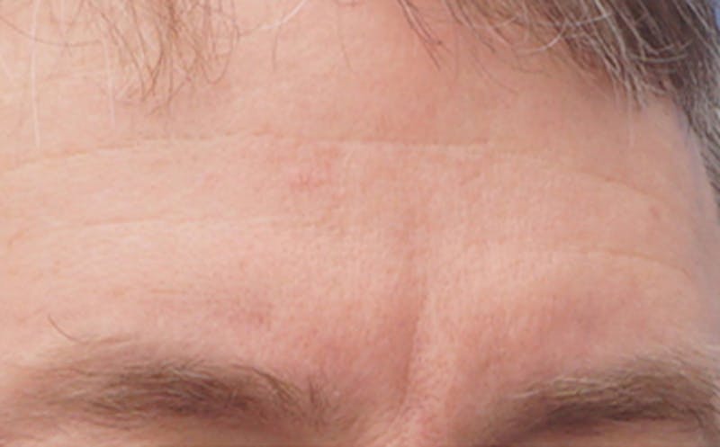 BOTOX Before & After Gallery - Patient 110930 - Image 1