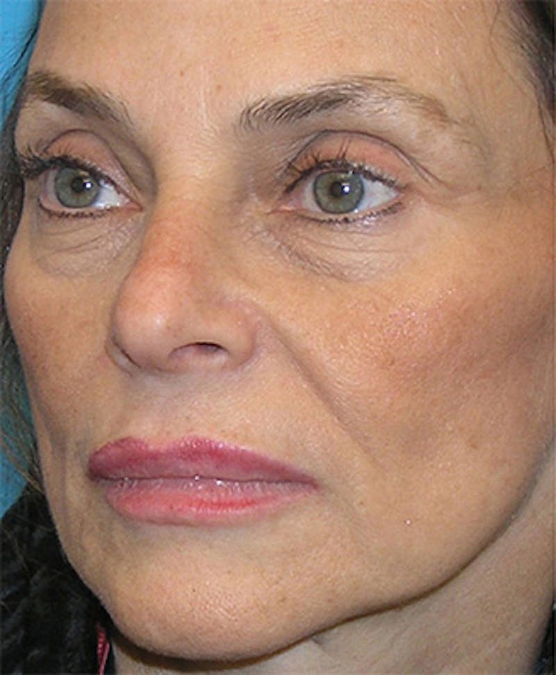 Facelift Before & After Gallery - Patient 295138 - Image 5
