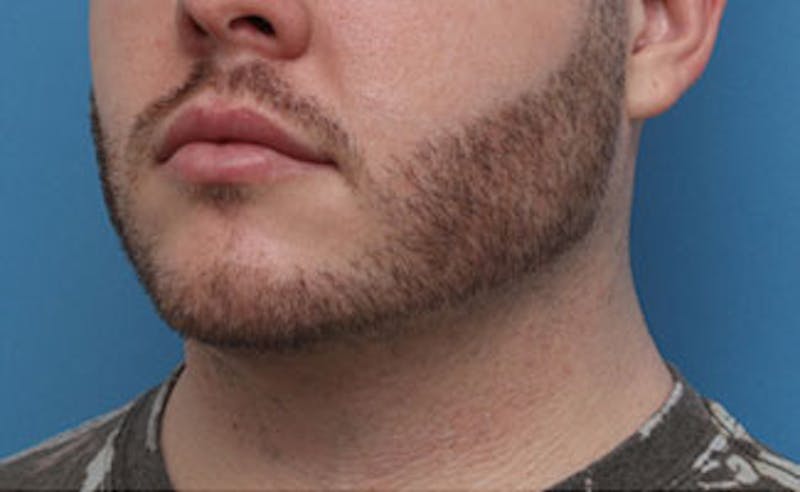 FaceTite Before & After Gallery - Patient 771200 - Image 7