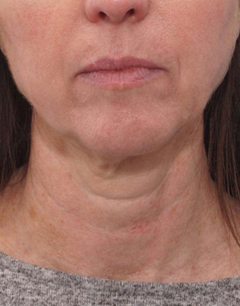 Jawline Contouring Before & After Gallery - Patient 170176 - Image 3