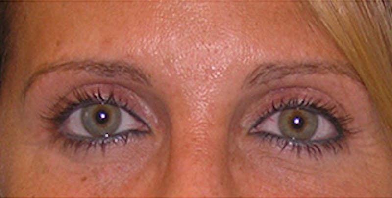 Eyelid Surgery Before & After Gallery - Patient 197125 - Image 2