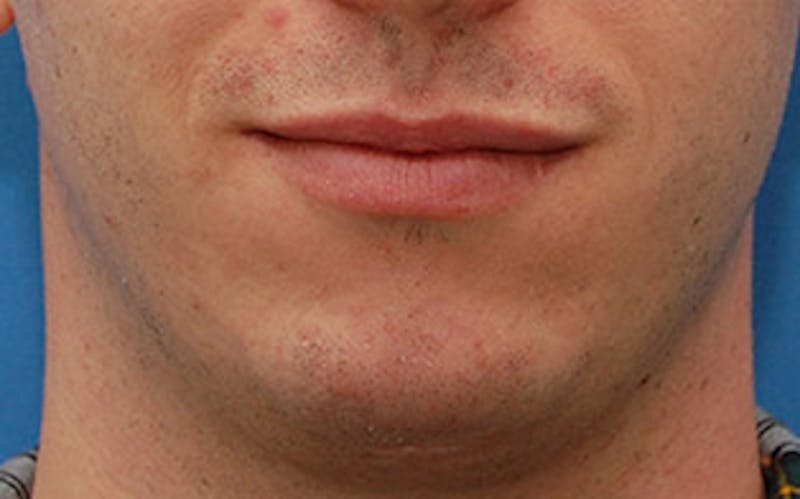Chin Surgery Before & After Gallery - Patient 259350 - Image 8