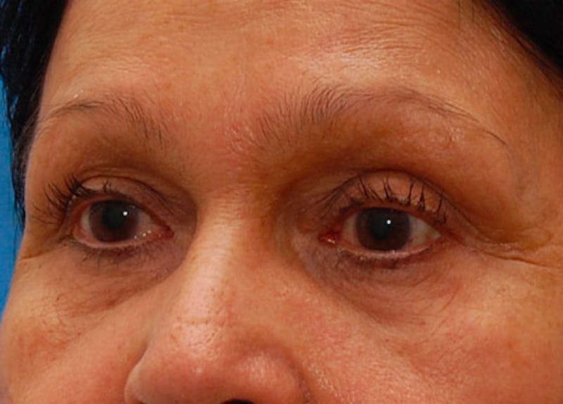 Fillers Before & After Gallery - Patient 416688 - Image 3