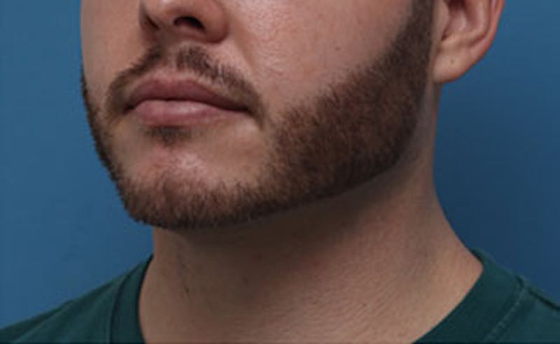 FaceTite Before & After Gallery - Patient 771200 - Image 8