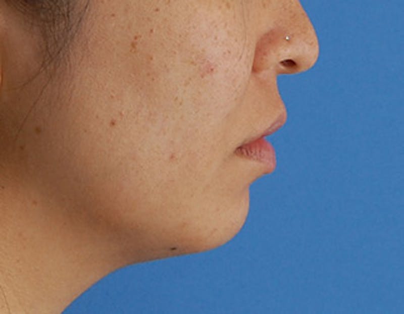 Kybella Before & After Gallery - Patient 379605 - Image 6