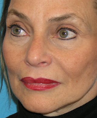Facelift Before & After Gallery - Patient 295138 - Image 2
