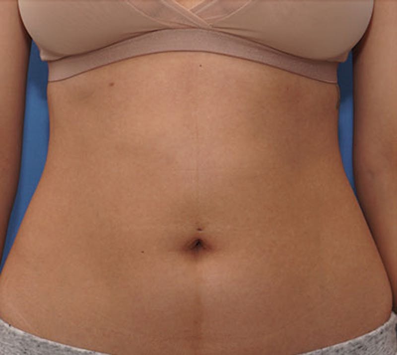 BodyTite Before & After Gallery - Patient 510146 - Image 1