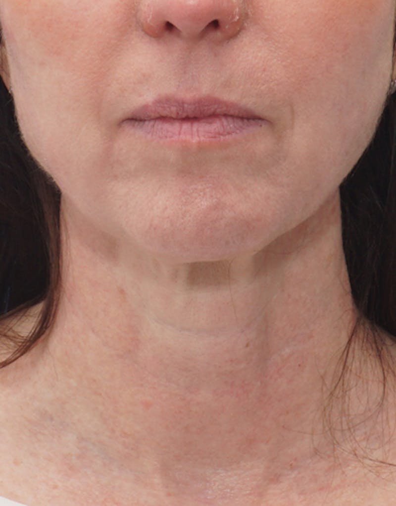 Jawline Contouring Before & After Gallery - Patient 170176 - Image 4