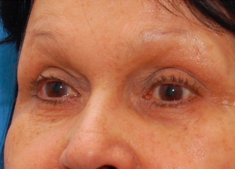 Fillers Before & After Gallery - Patient 416688 - Image 4