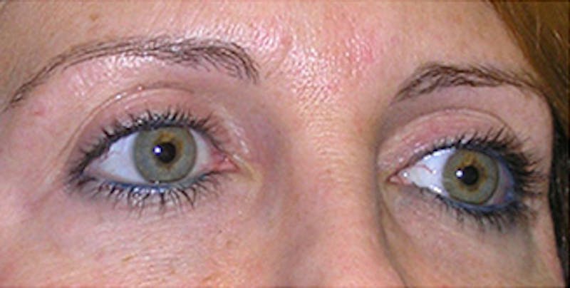 Eyelid Surgery Before & After Gallery - Patient 197125 - Image 3