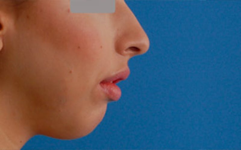 Chin Surgery Before & After Gallery - Patient 797225 - Image 1