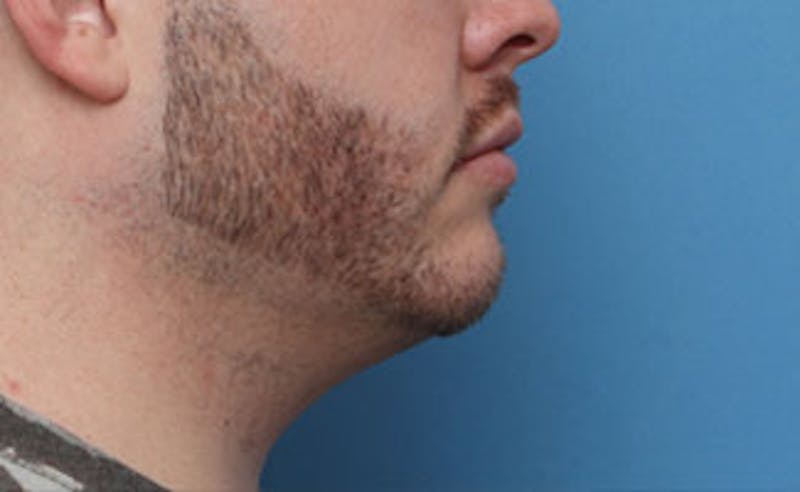 Patient NUuQ5zHMSHyUiQVVK8FuoQ - FaceTite Before & After Photos