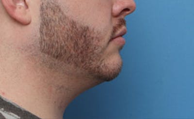 FaceTite Before & After Gallery - Patient 771200 - Image 1