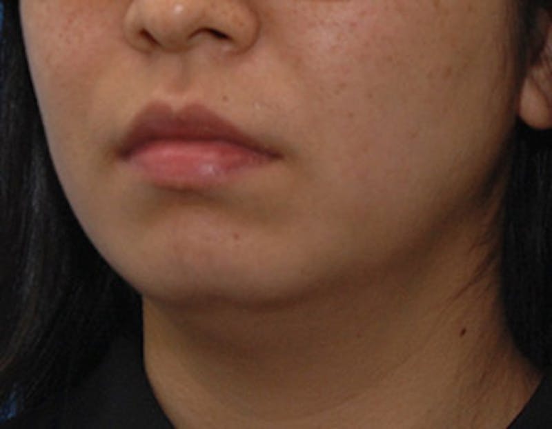 Kybella Before & After Gallery - Patient 379605 - Image 7
