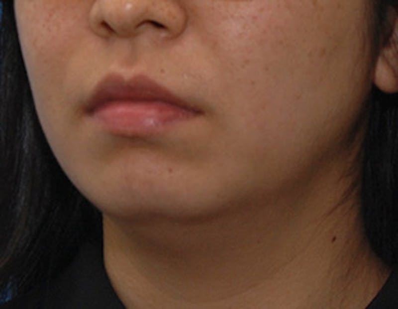 Kybella Before & After Gallery - Patient 379605 - Image 7