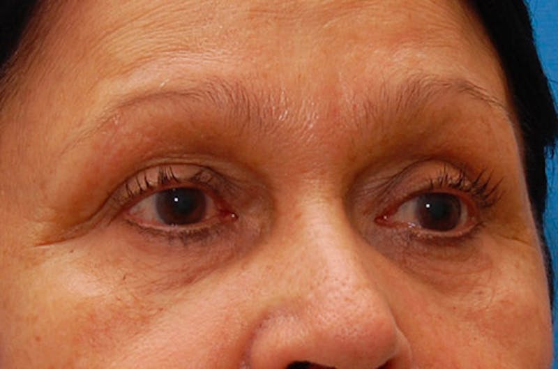 Fillers Before & After Gallery - Patient 416688 - Image 5