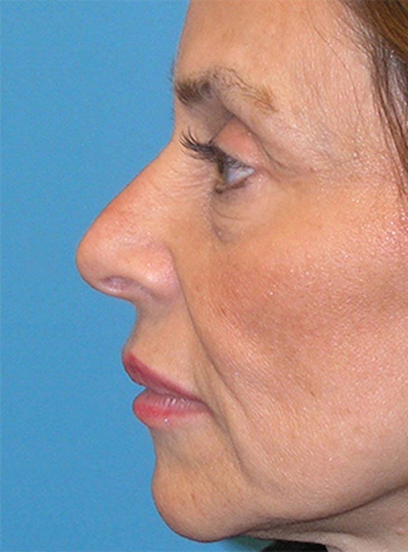 Facelift Before & After Gallery - Patient 295138 - Image 7