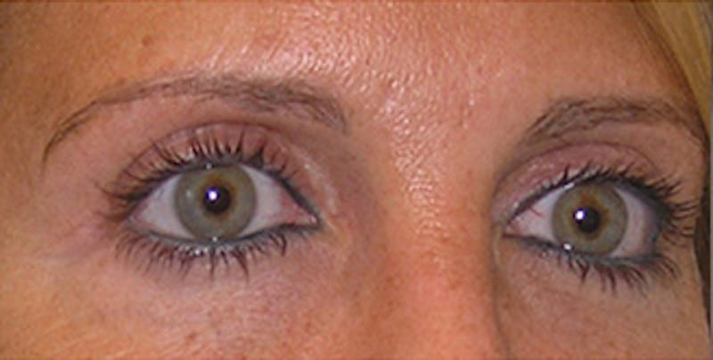 Eyelid Surgery Before & After Gallery - Patient 197125 - Image 4