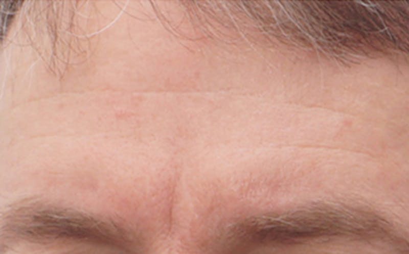 BOTOX Before & After Gallery - Patient 110930 - Image 3