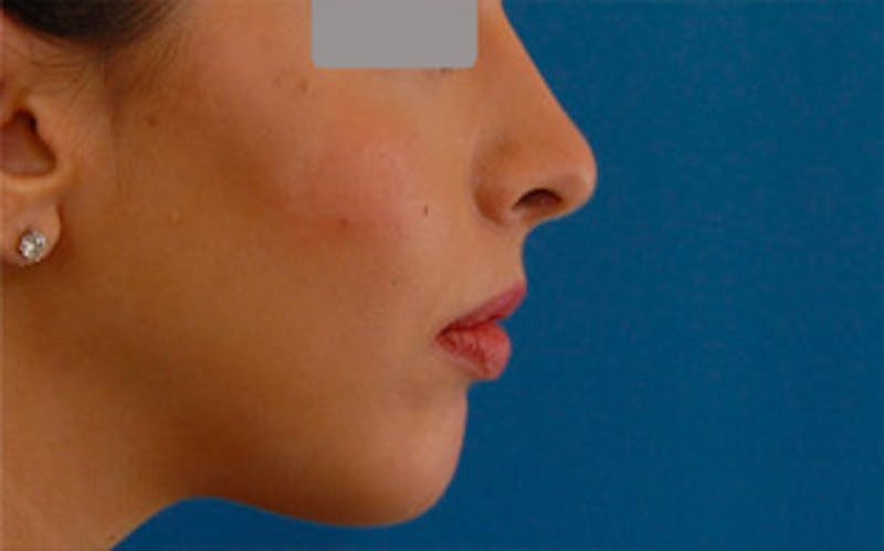 Chin Surgery Before & After Gallery - Patient 797225 - Image 2