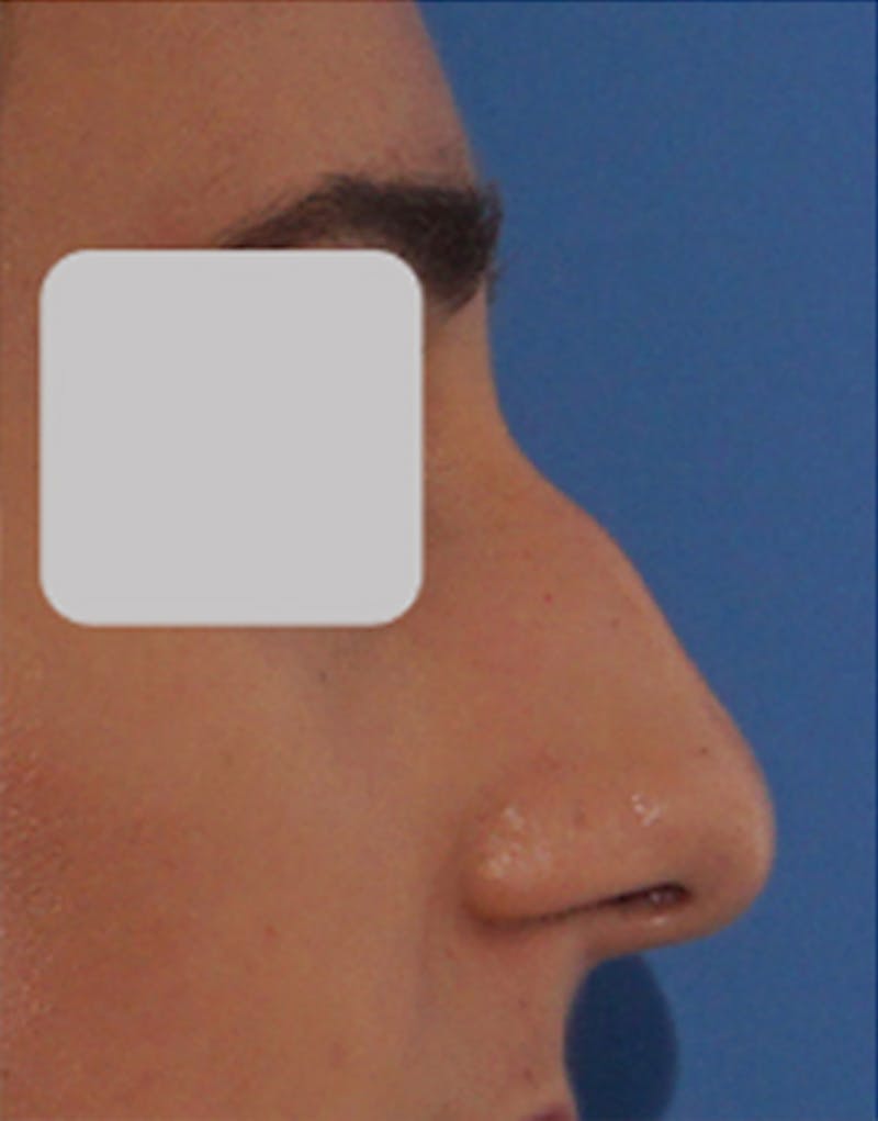 Rhinoplasty Before & After Gallery - Patient 914178 - Image 1