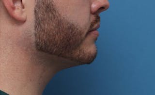 FaceTite Before & After Gallery - Patient 771200 - Image 2