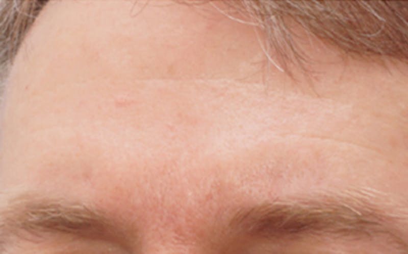 BOTOX Before & After Gallery - Patient 110930 - Image 4