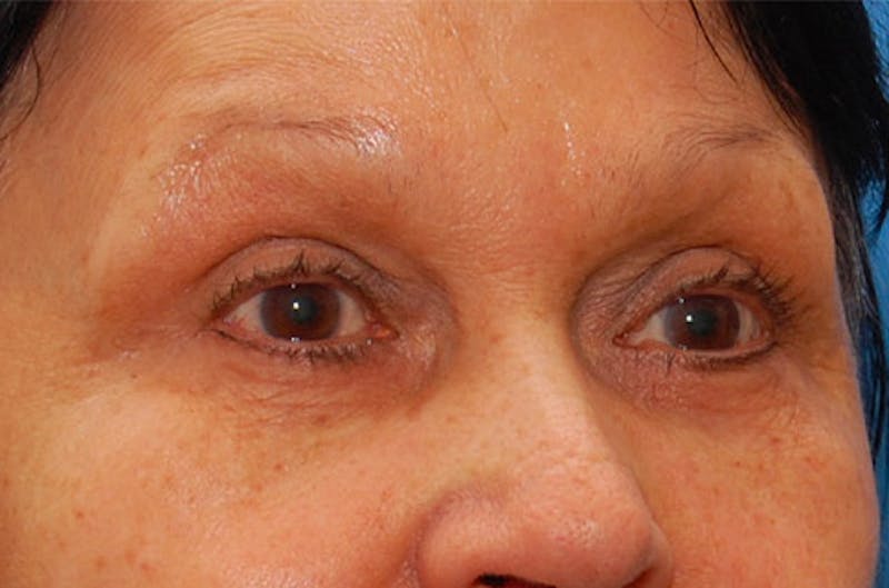 Fillers Before & After Gallery - Patient 416688 - Image 6