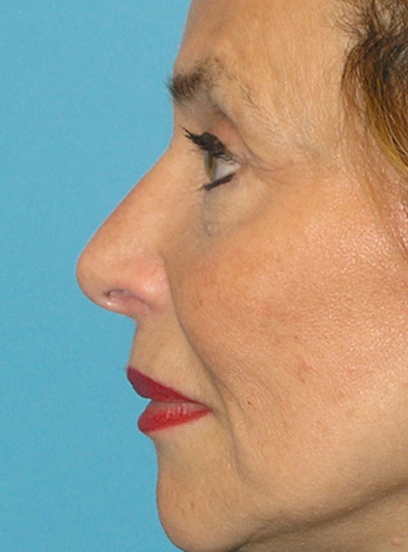 Facelift Before & After Gallery - Patient 295138 - Image 8