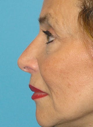 Facelift Before & After Gallery - Patient 295138 - Image 8