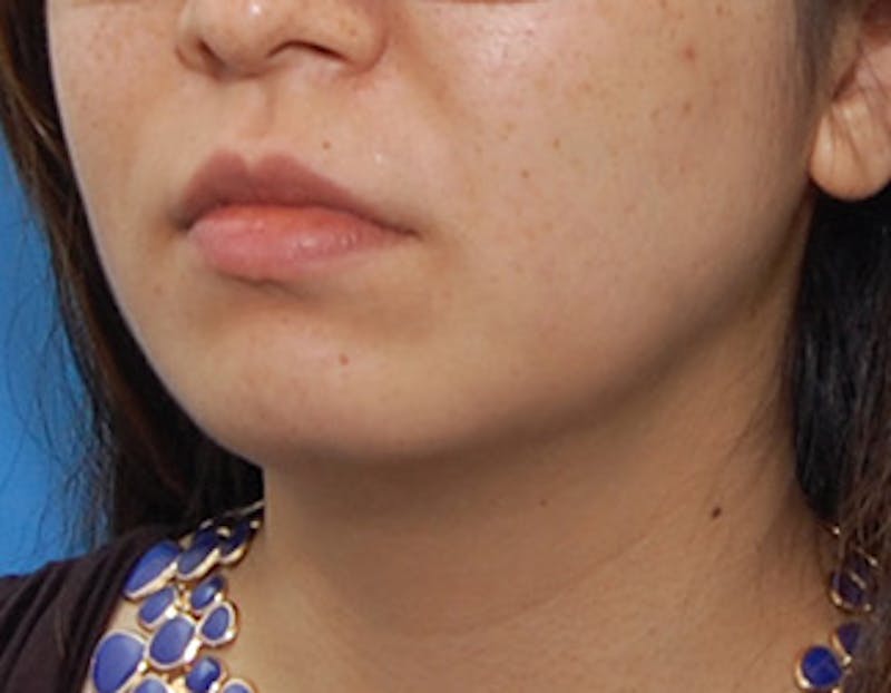 Kybella Before & After Gallery - Patient 379605 - Image 8