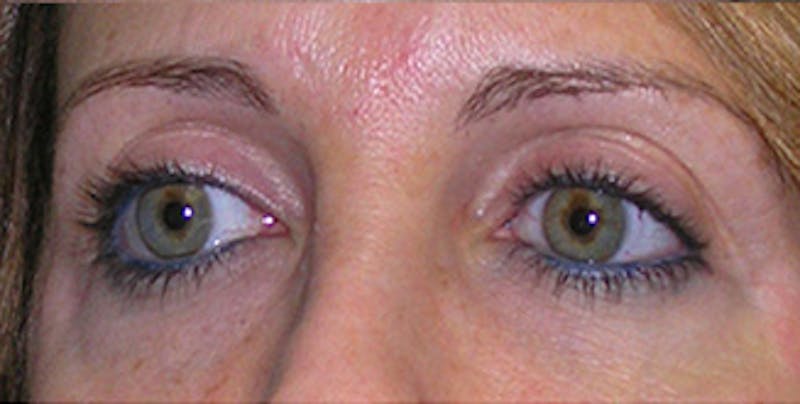 Eyelid Surgery Before & After Gallery - Patient 197125 - Image 5