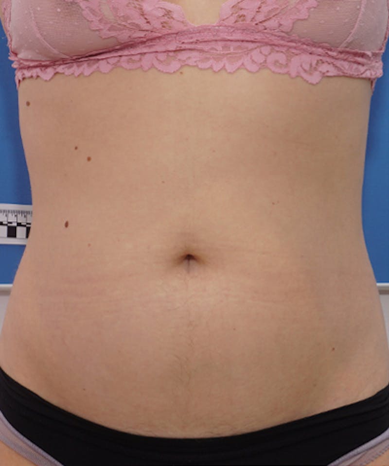 Patient fQUpTX3DRfqwVxicdMjiXQ - Morpheus8 Before & After Photos