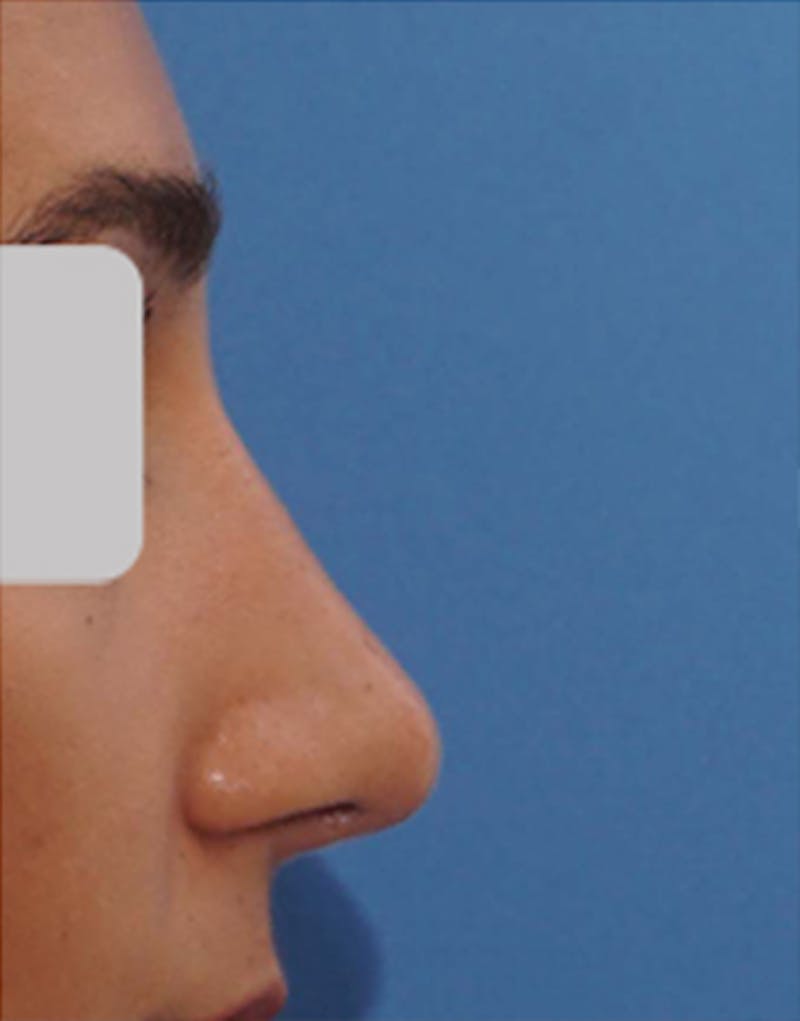 Rhinoplasty Before & After Gallery - Patient 914178 - Image 2