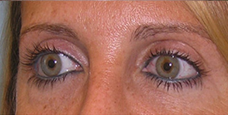Eyelid Surgery Before & After Gallery - Patient 197125 - Image 6