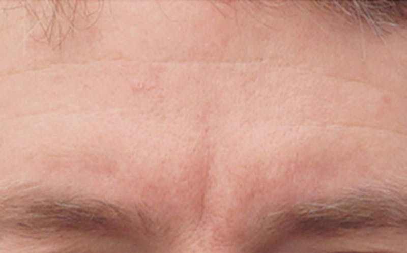 BOTOX Before & After Gallery - Patient 110930 - Image 5