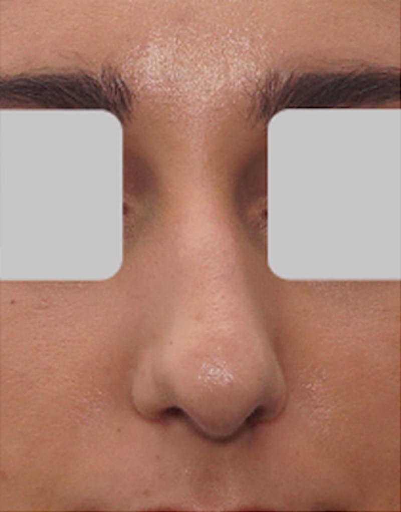 Rhinoplasty Before & After Gallery - Patient 914178 - Image 3
