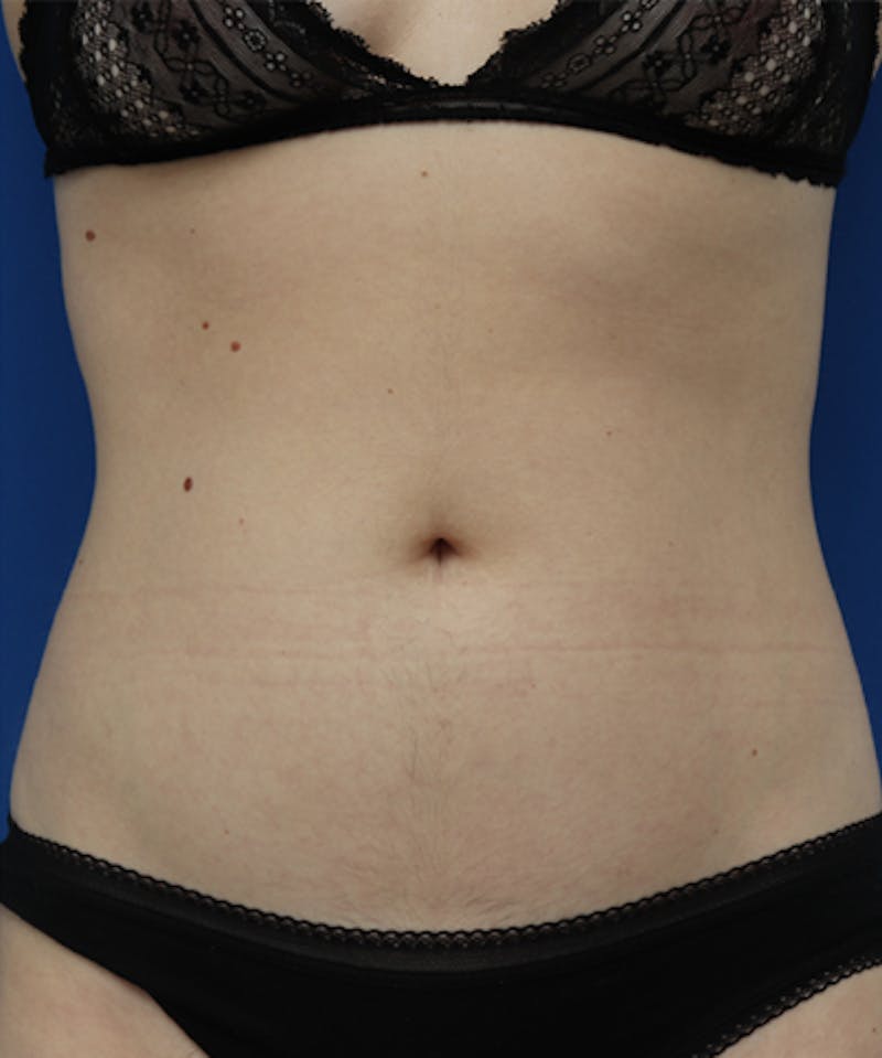 BodyTite Before & After Gallery - Patient 243327 - Image 2