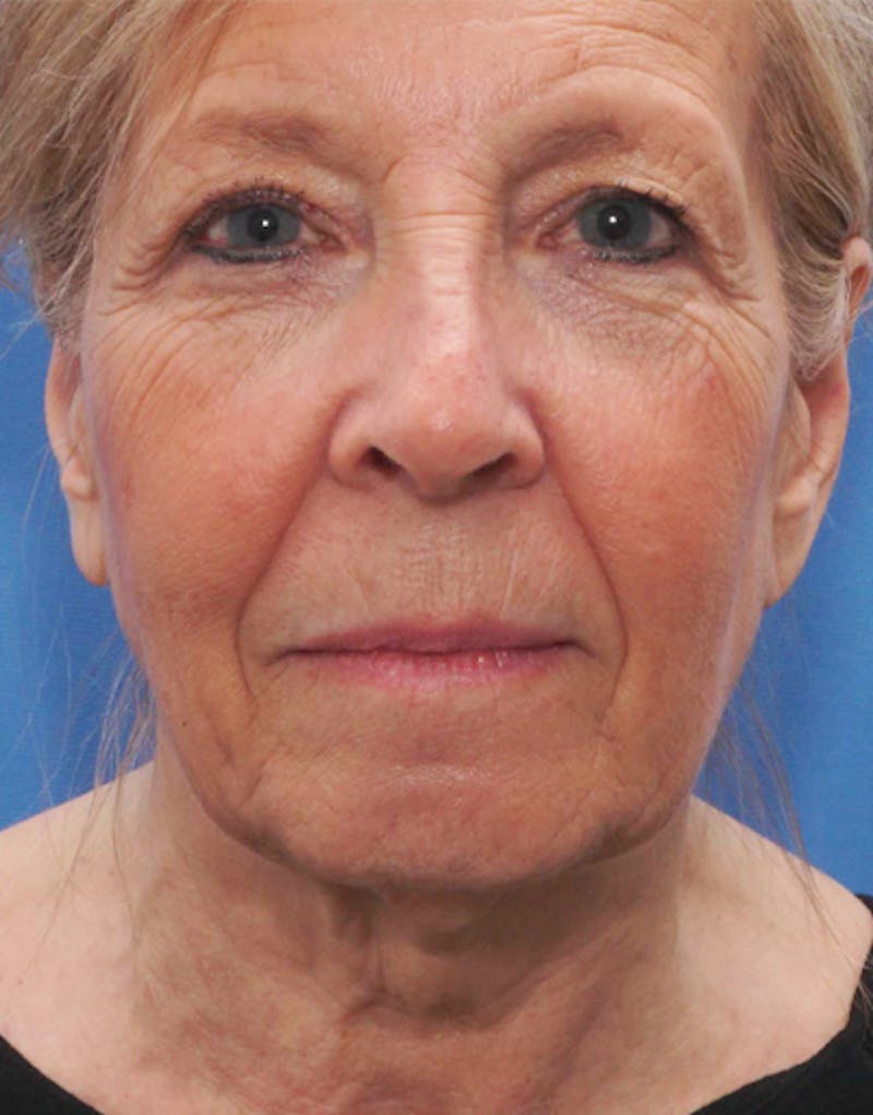 Patient BnFyhuj3Tw6C6yL5F1_59g - Facelift Before & After Photos