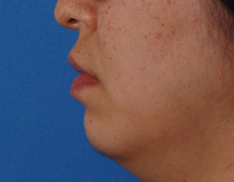 Kybella Before & After Gallery - Patient 379605 - Image 9