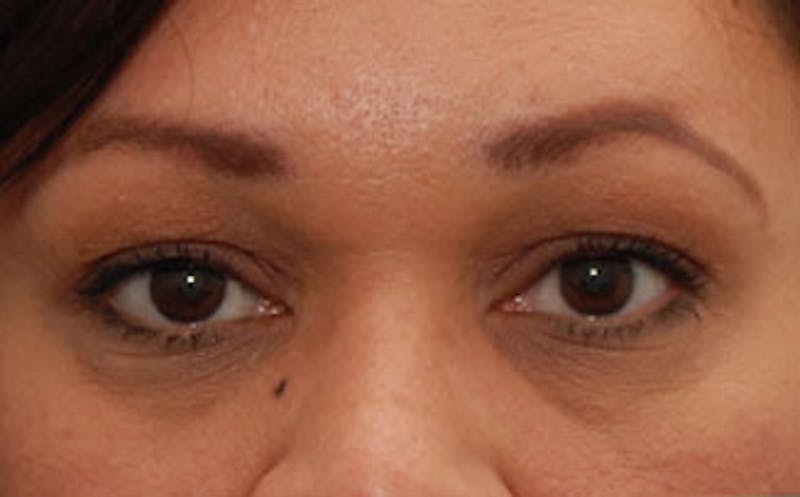Fillers Before & After Gallery - Patient 341310 - Image 1