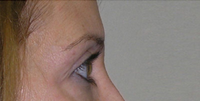 Eyelid Surgery Before & After Gallery - Patient 197125 - Image 7