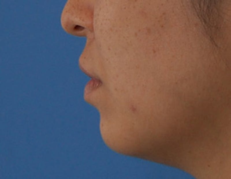 Kybella Before & After Gallery - Patient 379605 - Image 10