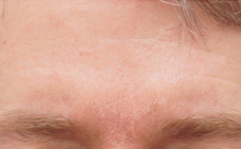 BOTOX Before & After Gallery - Patient 110930 - Image 6