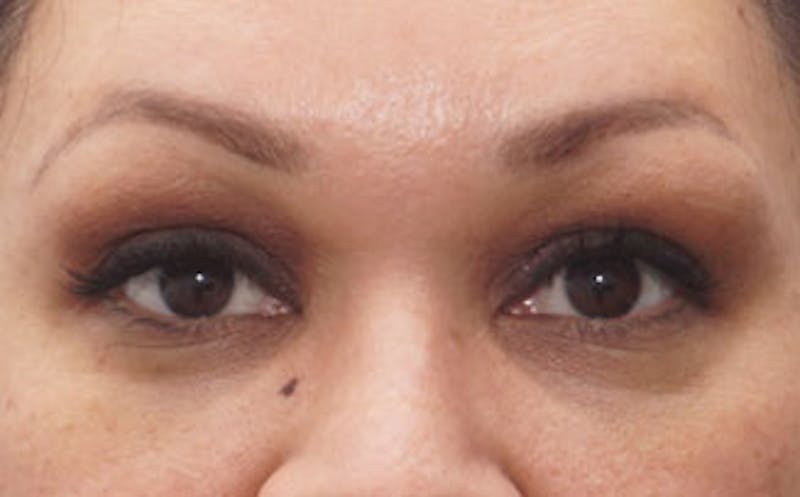 Fillers Before & After Gallery - Patient 341310 - Image 2