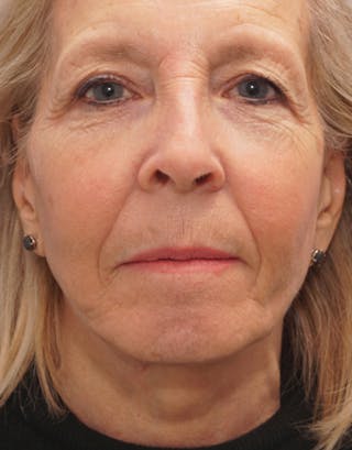 Facelift Before & After Gallery - Patient 112261 - Image 4