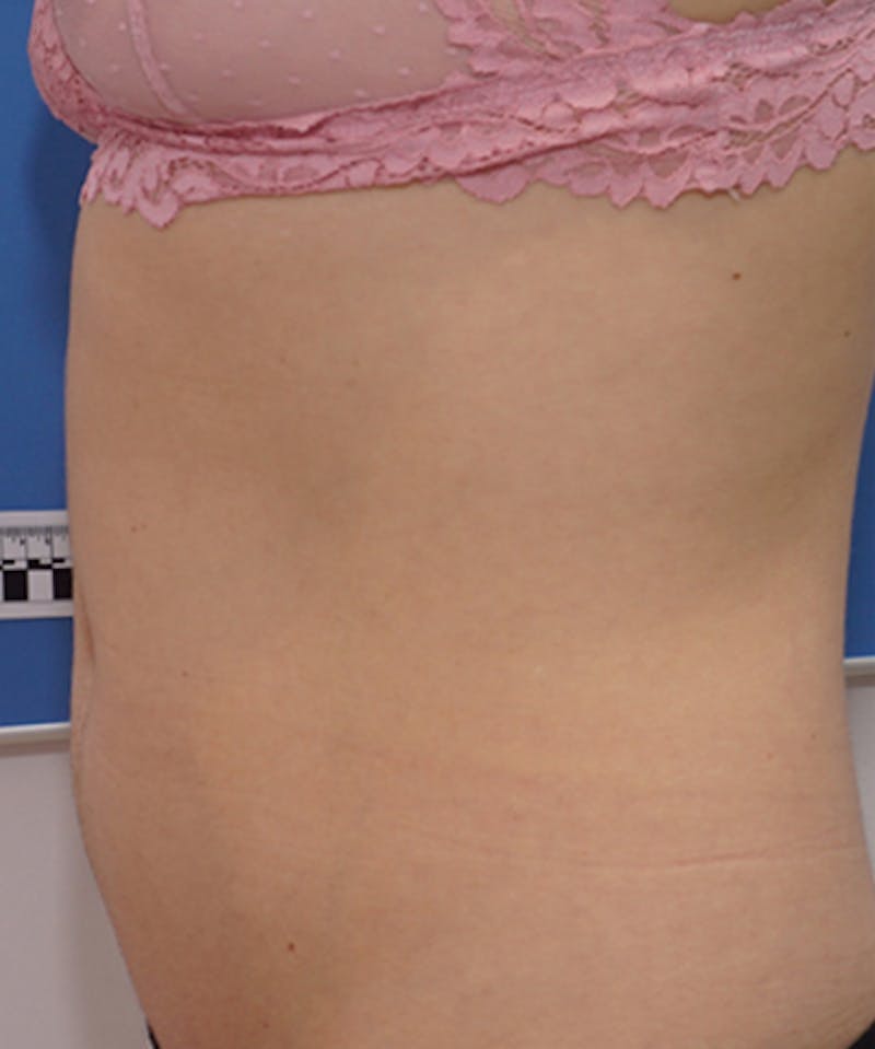 Fractora / Morpheus Before & After Gallery - Patient 137370 - Image 3